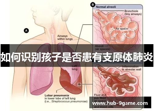 如何识别孩子是否患有支原体肺炎 如何识别孩子是否患有支原体肺炎